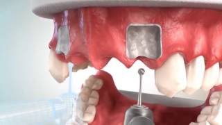 How to replace multiple teeth using dental implants