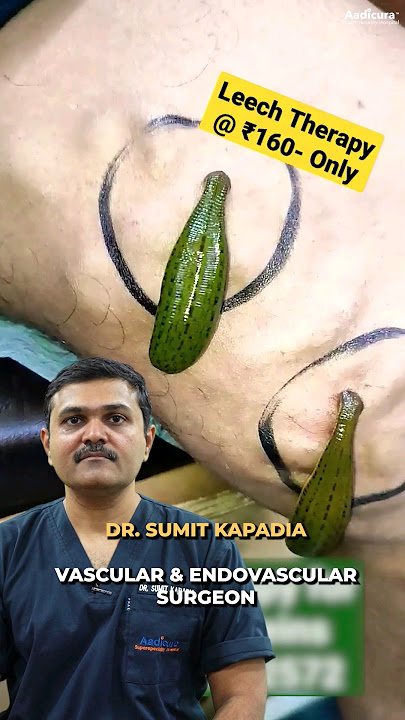 Leech Therapy for Varicose Veins! Does it work? #shorts
