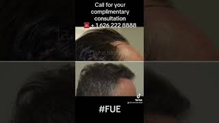 Before and After FUE Hair Transplant.  Best FUE Hair Restoration in Los Angeles California.