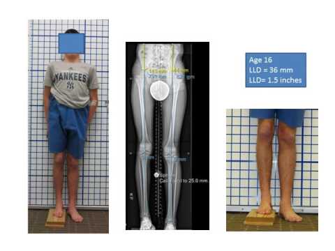 PRECICE Internal Lengthening Nail - PRECICE Internal Lengthening Nail