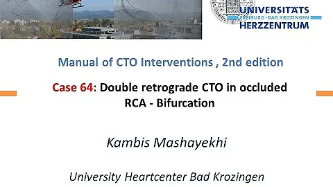 Case 64: Manual of CTO Interventions - Double retrograde for bifurcation at distal cap