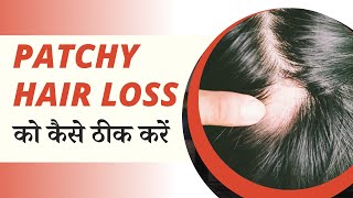 Patchy Hair Loss को कैसे ठीक करें | Patchy Hair Loss Treatment | Alopecia Areata Treatment | screenshot 5