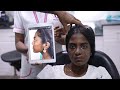 Cleft Rhinoplasty in India - Before &amp; After