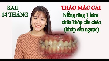 Niềng răng 1 hàm, không phải nhổ răng chữa khỏi khớp cắn chéo ( cắn ngược) sau 14 tháng