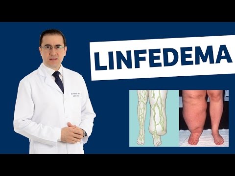 Linfedema - O que é e Como Prevenir o Linfedema | IMEB