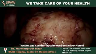 Fibroid Removal Surgery Success Story | Laparoscopic Treatment by Expert Gynaecologist