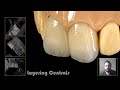 Layering central incisors by understanding the ceramic powders IN ENGLISH
