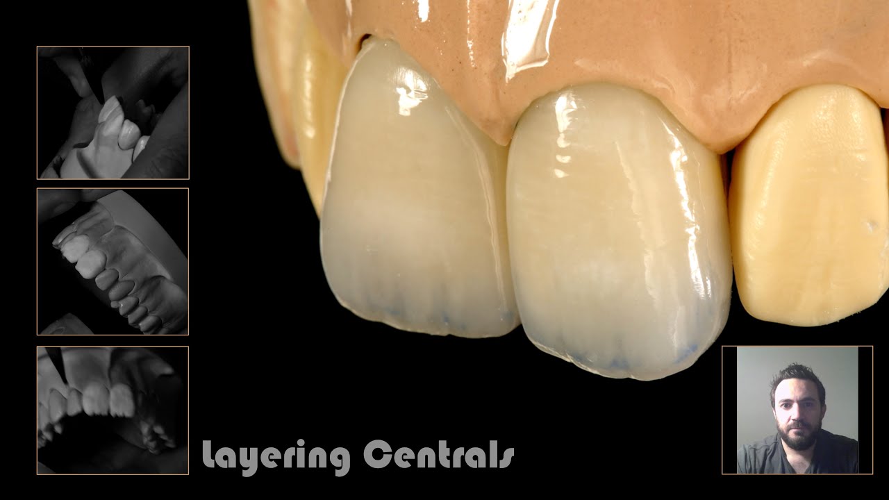 Layering central incisors by understanding the ceramic powders IN