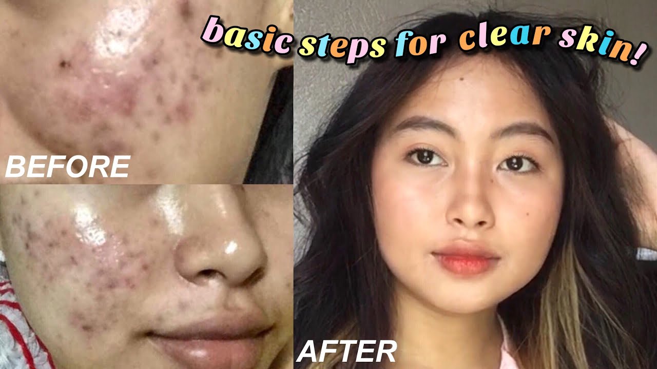 HOW I CLEARED MY FACE IN JUST 1 MONTH | updated routine + acne journey ...