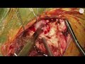 Retromastoid craniotomy preview