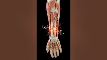 What Happens When You Break a Bone in 3D