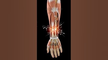 What Happens When You Break a Bone in 3D