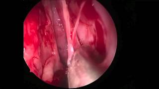 Download Endoscopic Ultrasonic Dacryocystorhinostomy For Recurrent Dacryocystitis Followi Video MP3 Endoscopic Ultrasonic Dacryocystorhinostomy For Recurrent Dacryocystitis Followi