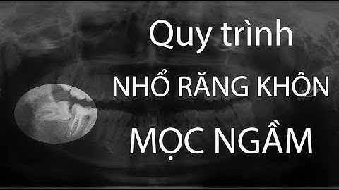 Procedure Show - Nhổ răng khôn mọc ngầm, lệch 90 độ đâm hỏng răng số 7