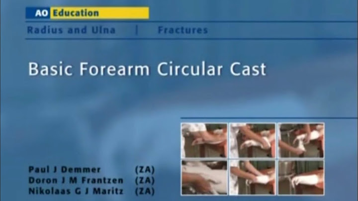 Hướng dẫn cách bó bột