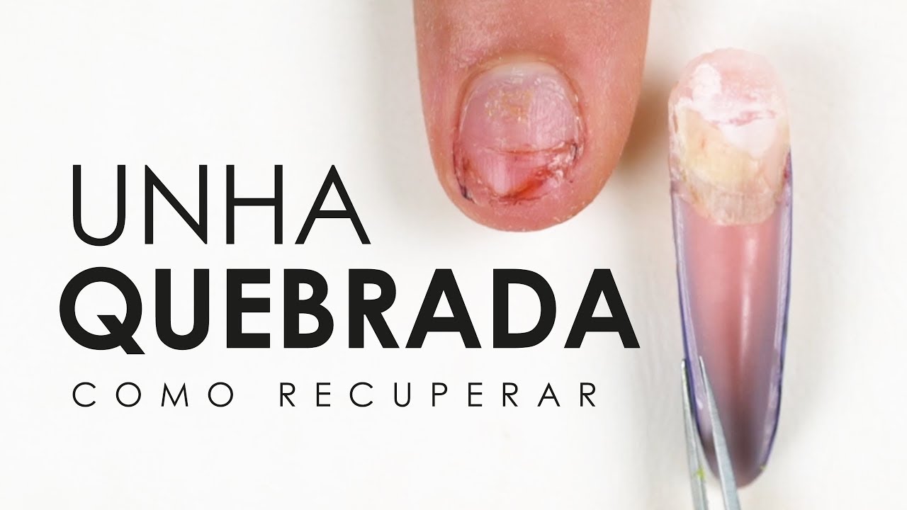Recuperação de Unha Quebrada - YouTube