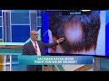 Saç kıran nasıl tedavi edilir? Balçiçek ile Dr. Cankurtaran 50. Bölüm