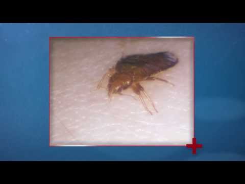 Video: Bed Bugs As Carriers Of Infection