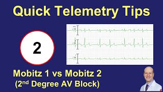 Telemetry Tips - 2nd Degree AV Block (Mobitz 1, Mobitz 2, and 2:1)