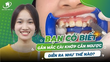 Các Bạn Niềng Răng Chữa Móm Nên Biết Điều Này