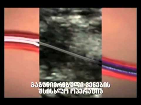 ვენების ვარიკოზული გაგანიერება