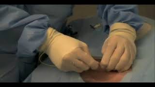 Placing a Blind Internal Jugular Central Line