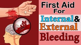 First Aid for External & Internal Bleeding | Great Wall Corporate Services