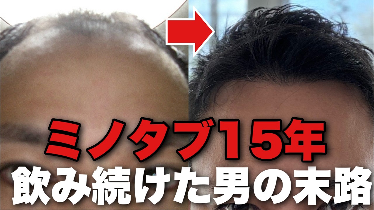 若ハゲがAGA治療でミノタブを15年継続した経過を公開