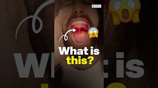 What is the Uvula? Secret Function of That Hanging Thing in Throat. #gblbaralahospital What is the Uvula? Secret Function of That Hanging Thing in Throat. #gblbaralahospital