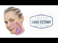 Facelift 101: The Differences Between Different Types of Facelifts | Aesthetic Minutes #Facelift