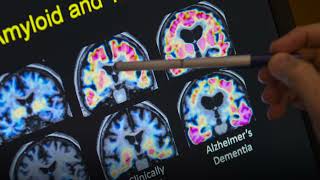 Alzheimers Awareness Month