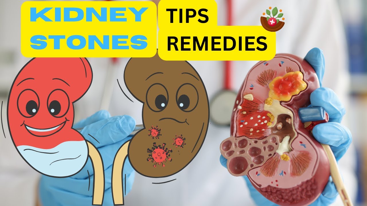 Dietary Tips and Natural Remedies for Kidney Stones Prevent Kidney Stones Health YouTube