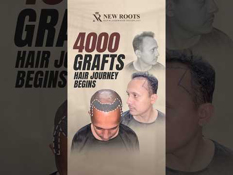 Hair Transplant in Lucknow | Hair Transplant Cost & Results in Lucknow #hairtransplant #shorts