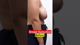 How To Fix Saggy Breasts | Breast reduction Surgery shorts