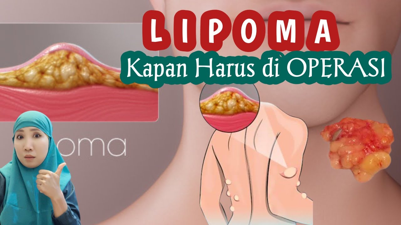 ЛИПОМА || КОГДА НУЖНО ДЕЛАТЬ ОПЕРАЦИЮ