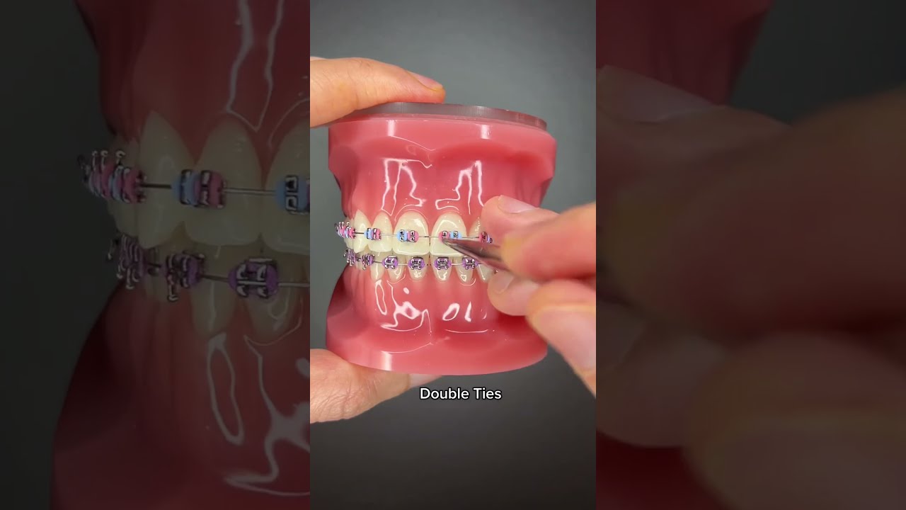 Different Types Of Orthodontic Ties You Can Get At Your Orthodontist Part 1