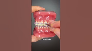 Different Types of Orthodontic Ties you can get at your Orthodontist Part 1