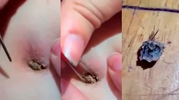 O que é uma bolinha preta no umbigo?