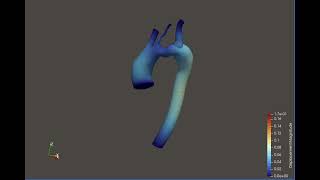 Wall Displacement --- Fluid-Structure-Simulation (FSI) of Patient Specific Aorta Model Wall Displacement --- Fluid-Structure-Simulation (FSI) of Patient Specific Aorta Model