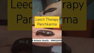 leech therapy | Panchkarma | Ayurveda
