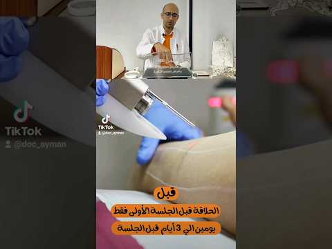 ازالة الشعر بالليزر امتى تحلقي الشعر بين الجلسات