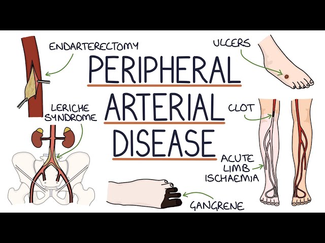 Understanding Peripheral Arterial Disease class=