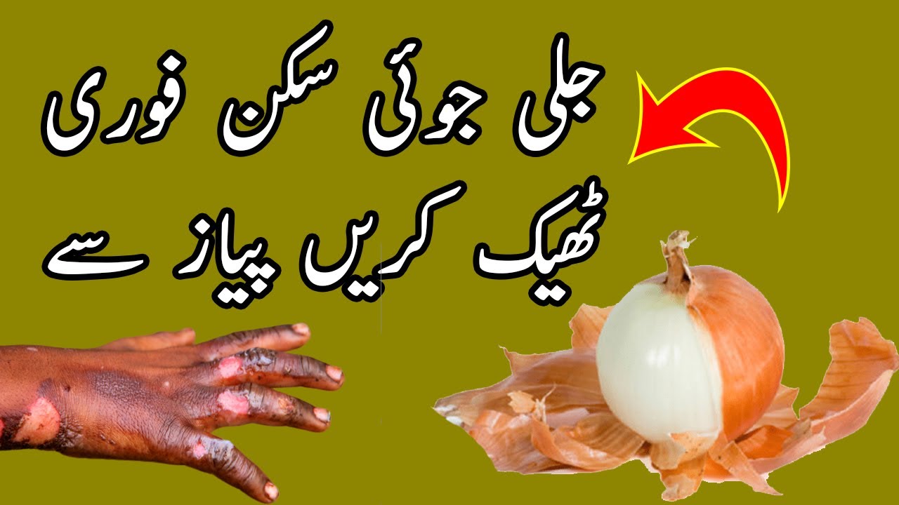 Burn Skin Treatment Home Remedy in Urdu Skin Jal Jaye To Kia Kare