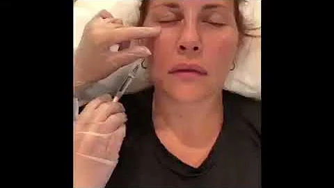 Before & After - Belotero Tear Trough Injections w...