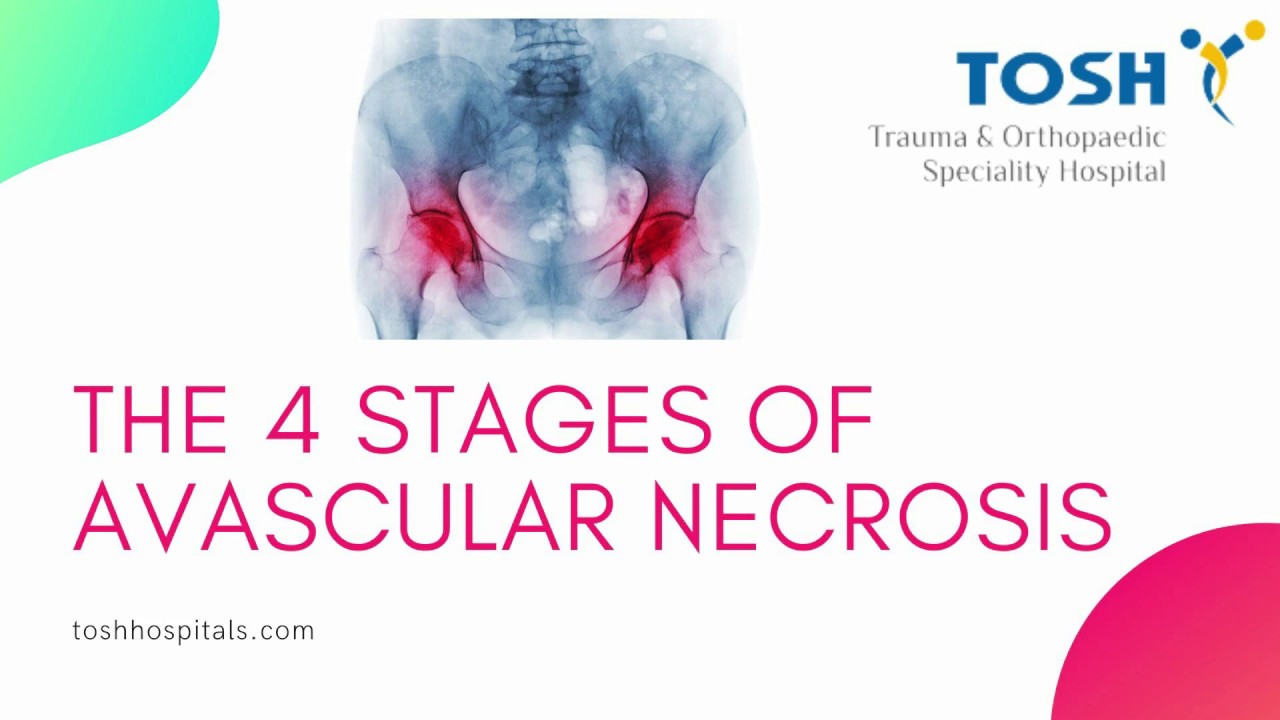 Avascular Necrosis Treatment