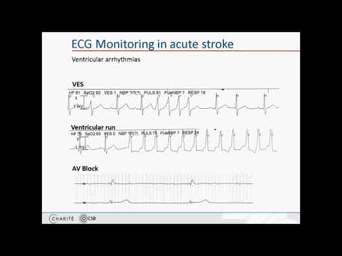 Cardiac complications in acute stroke