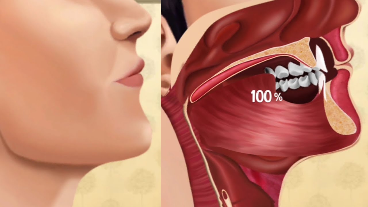 ASMR Sleep Apnea by Placing Suspension Lines | Treatment of Sleep apnea ...