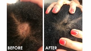 HOW I GREW OUT MY BALD SPOT IN JUST 2 WEEKS!  Video &amp; Photos Included! (before &amp; After)