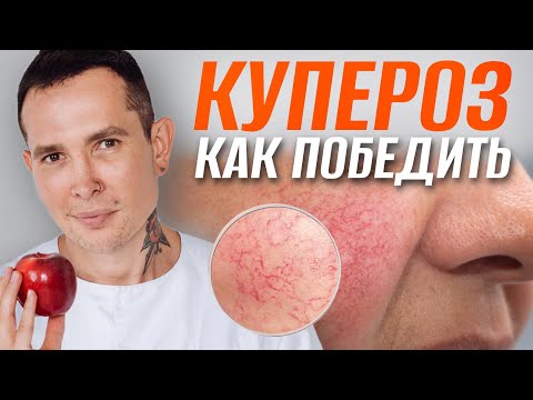 КУПЕРОЗ как победить | Полное пособие #купероз