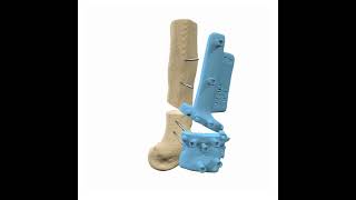 3D-Cut - Correction Of A Distal Femur Osteomy